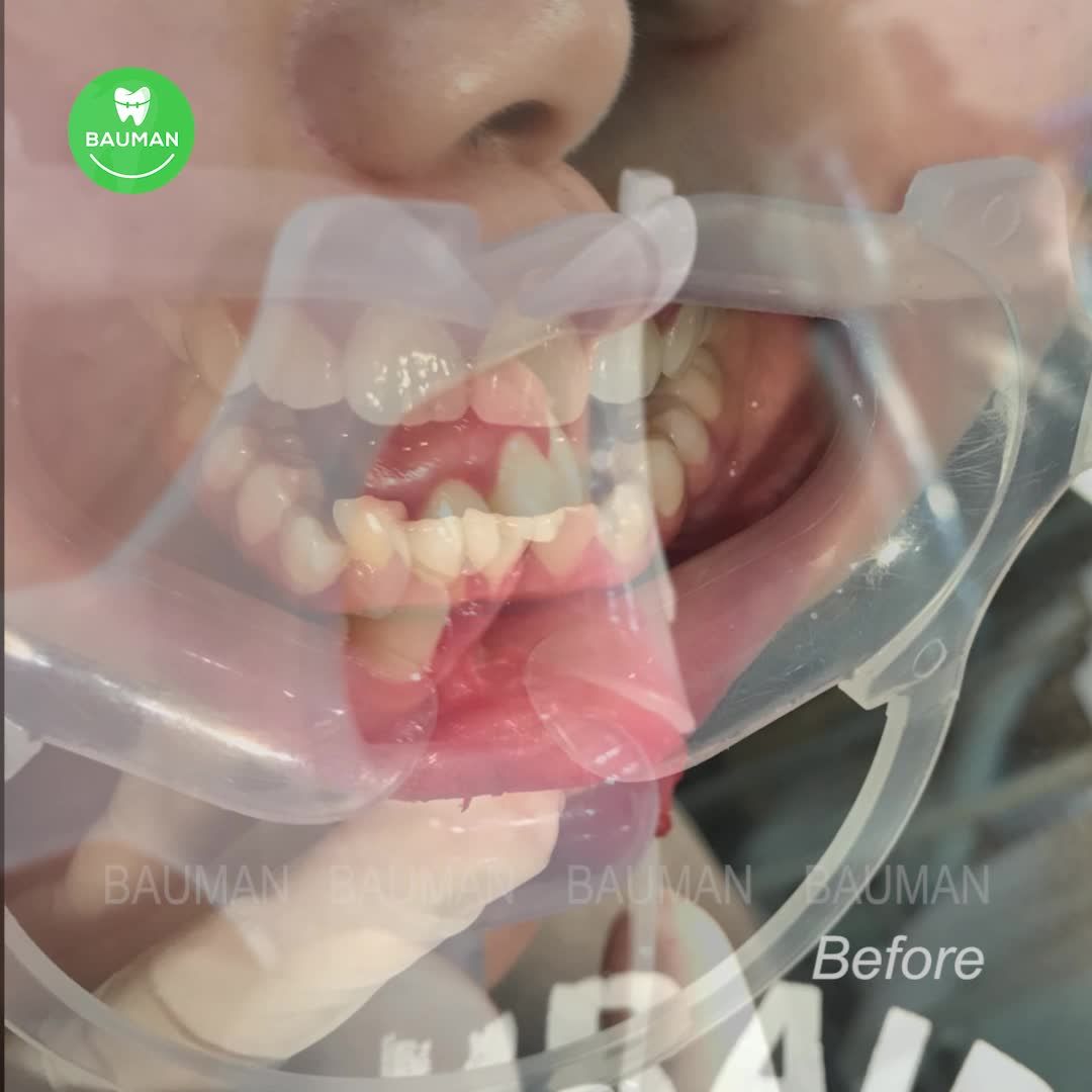 Ca niềng răng 5239| Nha Khoa Bauman