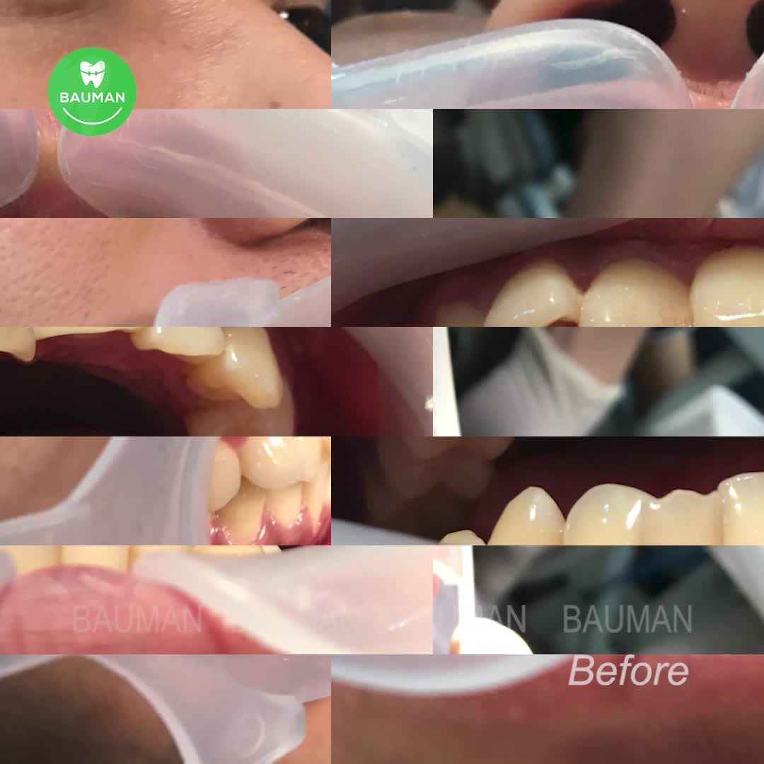 Ca niềng răng 5240| Nha Khoa Bauman