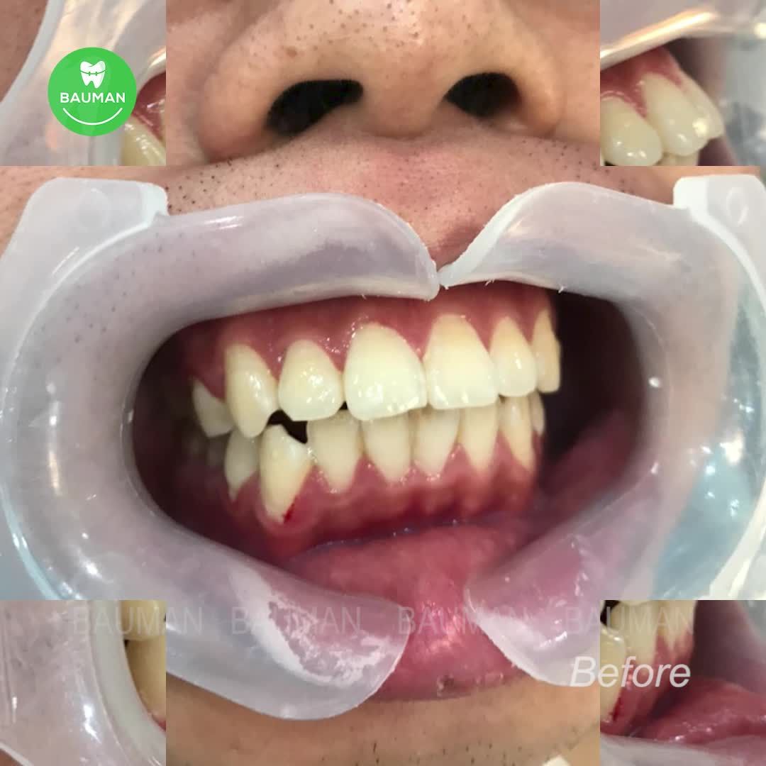 Ca niềng răng 5241| Nha Khoa Bauman