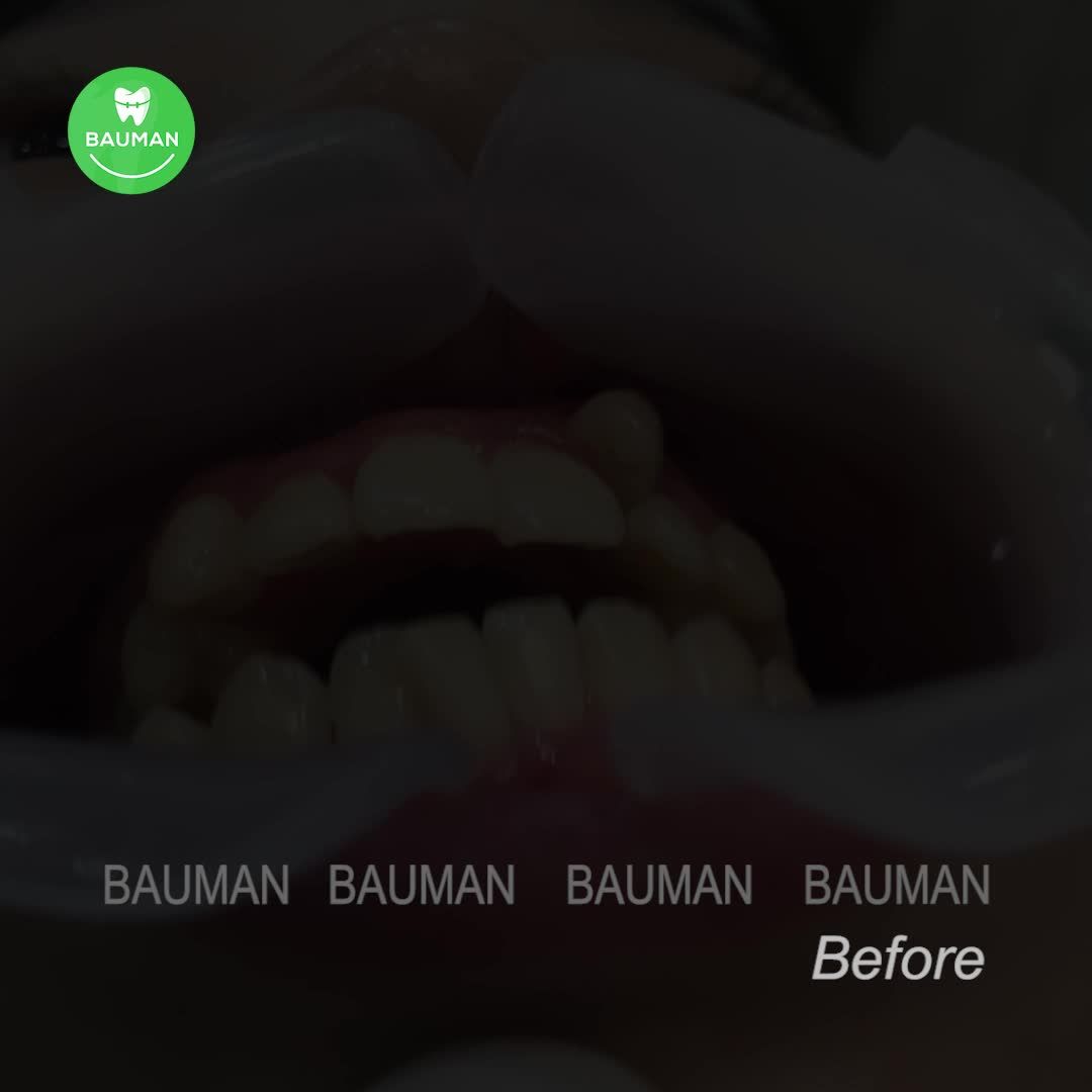 Ca niềng răng 5242| Nha Khoa Bauman