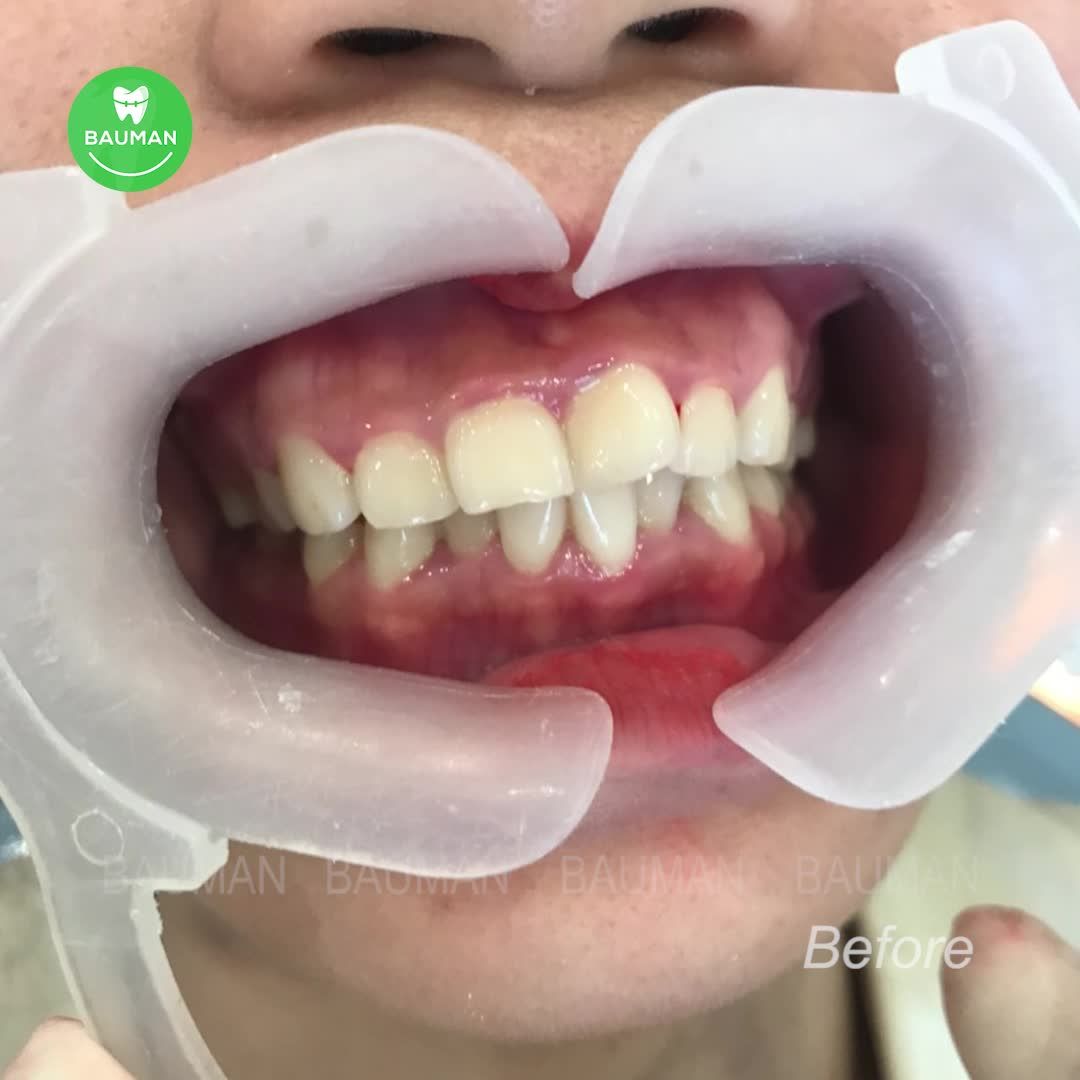 Ca niềng răng 5243| Nha Khoa Bauman