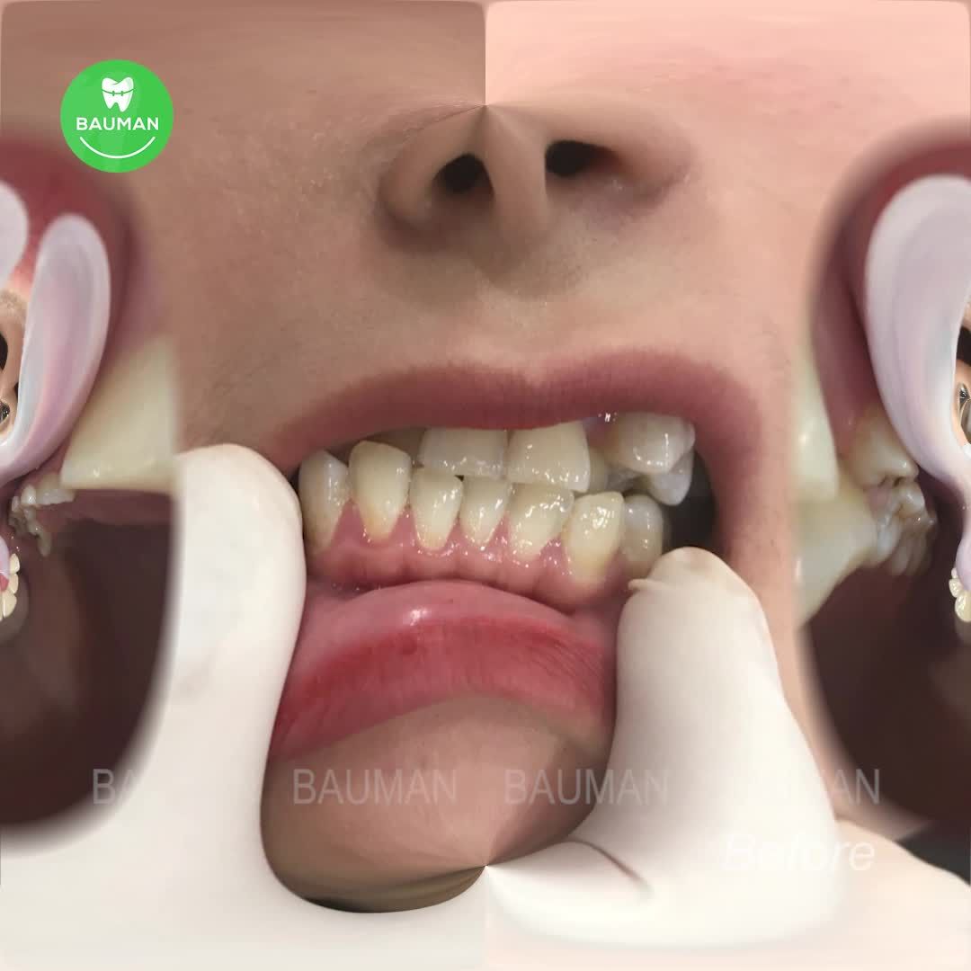 Ca niềng răng 5244| Nha Khoa Bauman