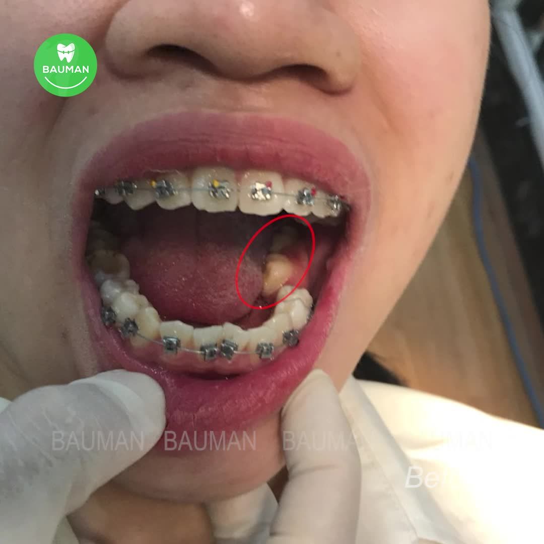 Ca niềng răng 5245| Nha Khoa Bauman