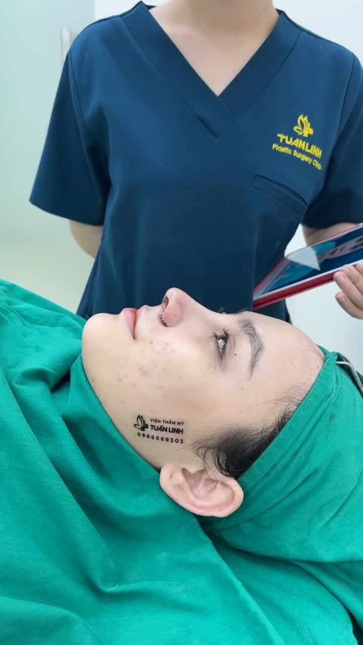 Thay đổi ''ngoạn mục'' sau 90 phút nâng mũi siêu cấu trúc ( tặng sụn Surgiform) cho bạn gái đến từ ĐỒNG NAI