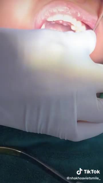 GẮN BAND NIỀNG RĂNG RA SAO VÀ CÓ TÁC DỤNG GÌ