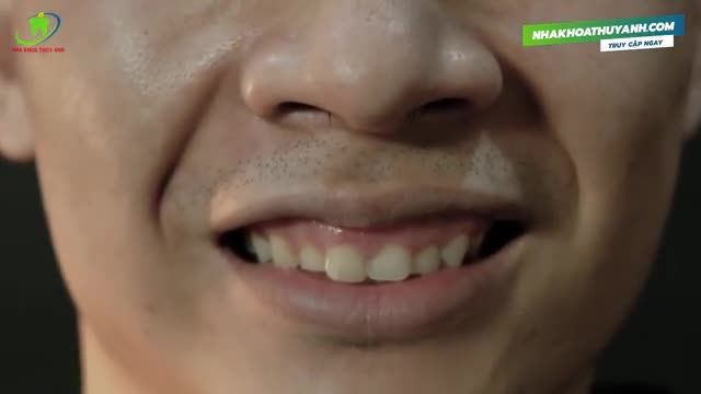 GIẢI PHÓNG NỤ CƯỜI HỞ LỢI CHỈ SAU  45P