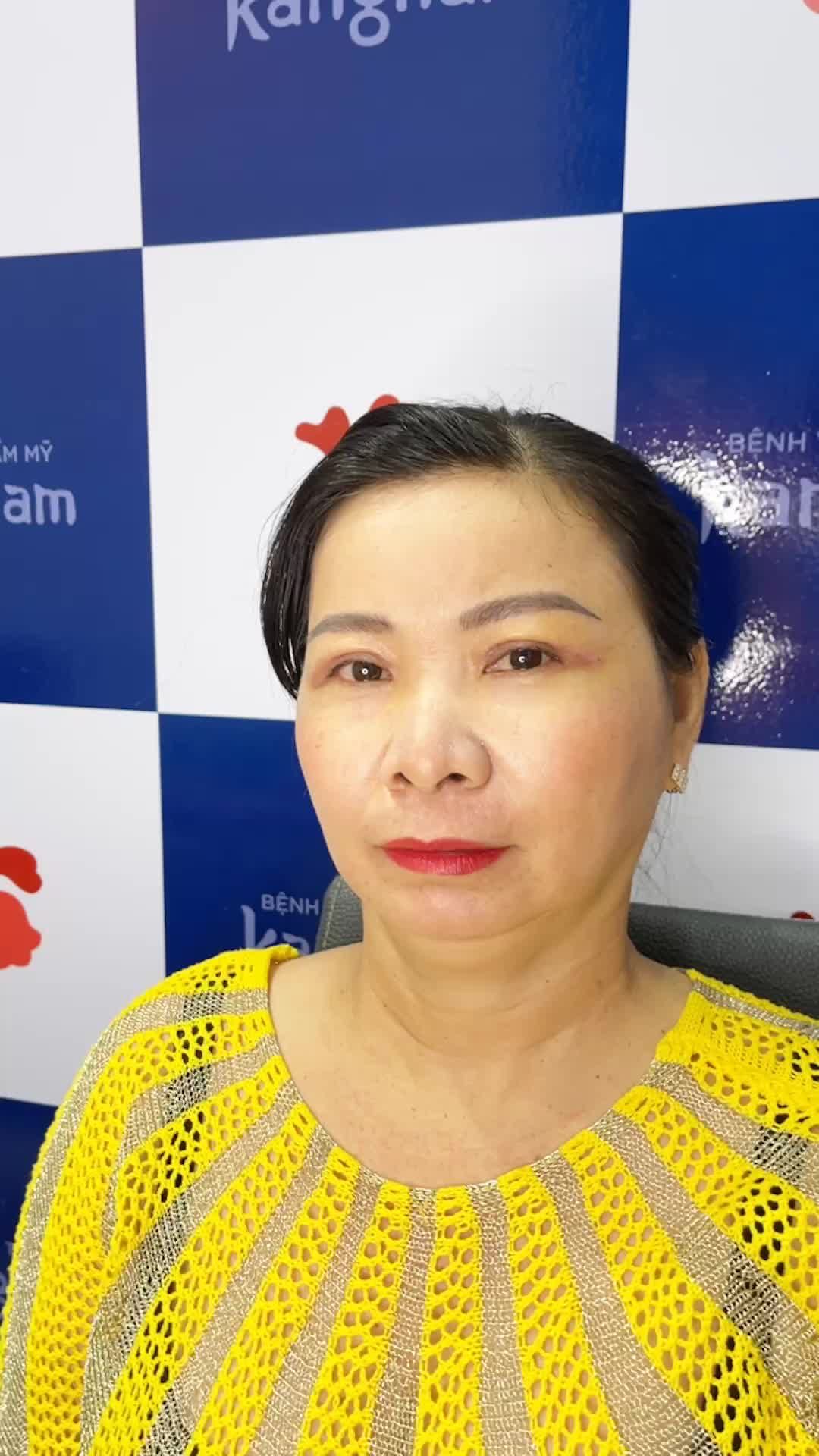 Lấy lại tuổi thanh xuân với dịch vụ Cắt mí trên Plasma