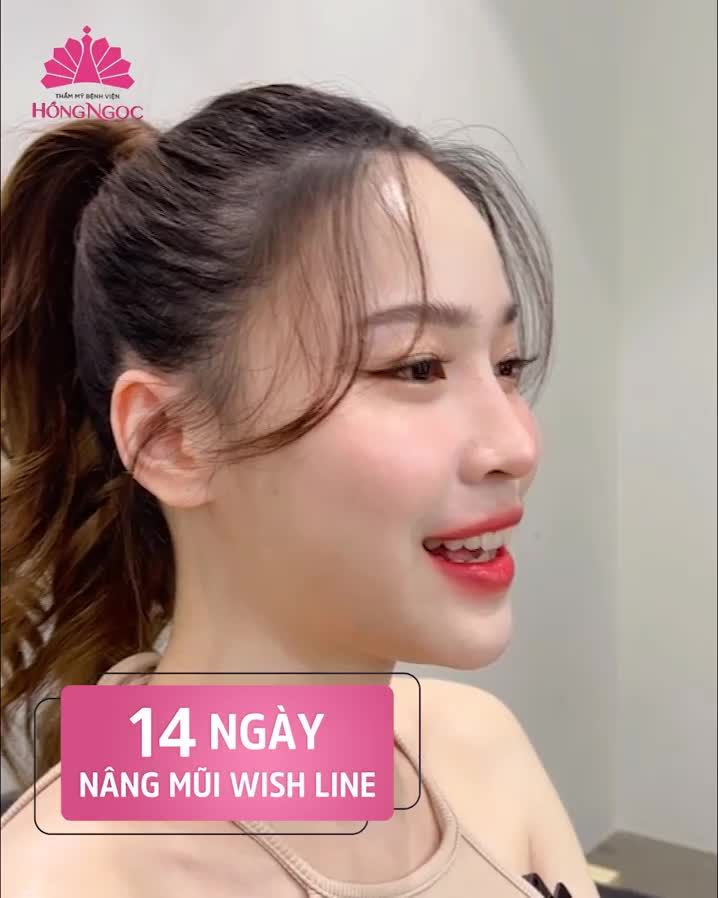 LÊN ĐỜI NHAN SẮC SAU 2 TUẦN NÂNG MŨI WISH LINE