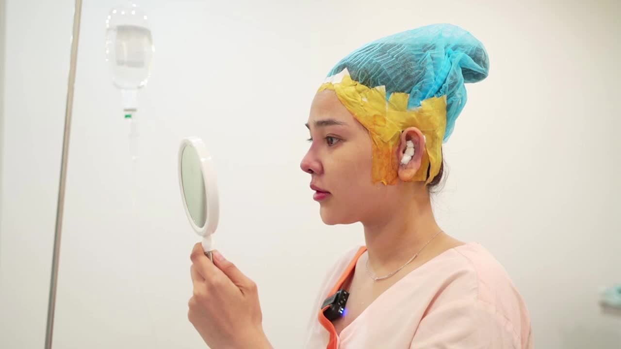 Nâng mũi cấu trúc sụn tai sóng Nanoform