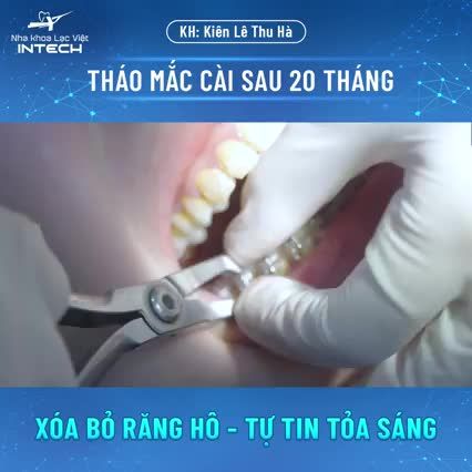 THÁO MẮC CÀI SAU 20 THÁNG