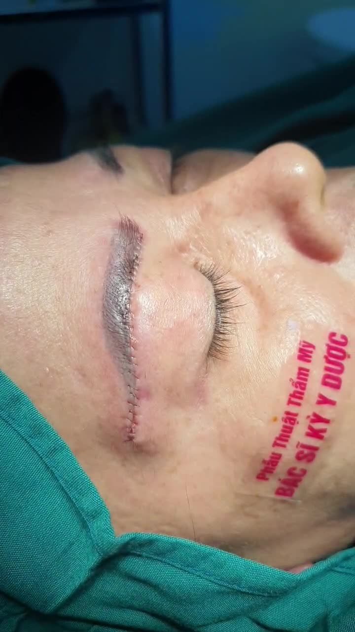 TREO CUNG MÀY CHO CÔ KHÁCH U60