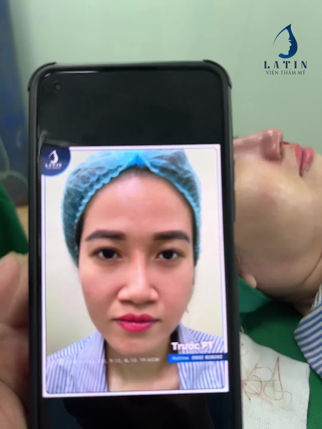 LIVESTREAM Khách đã nâng mũi chỉ - sửa lại như thế nào