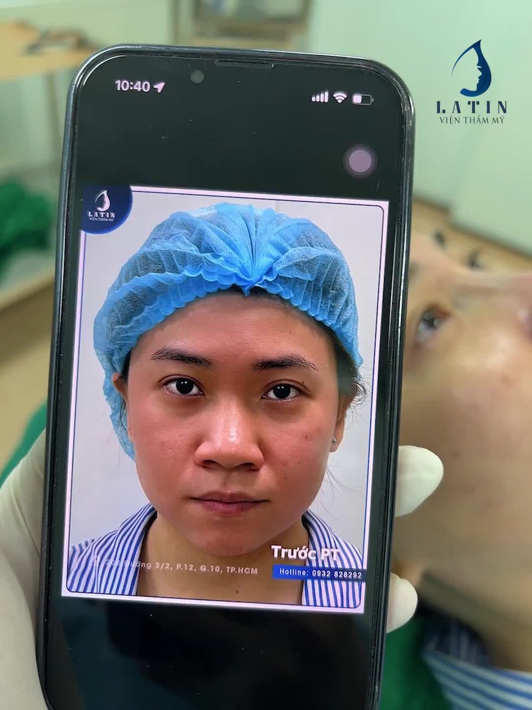 LIVESTREAM Khách hàng sở hữu nền mũi với nhiều khuyết điểm như sống mũi khá thấp, cánh mũi rộng, to bè.