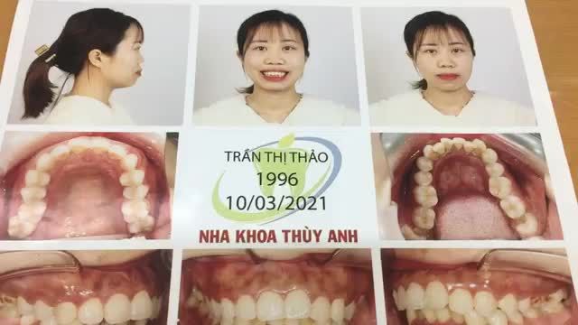 Ca cắm vis hỗ trợ trong quá trình chỉnh nha tại Nha Khoa Thuỳ Anh.