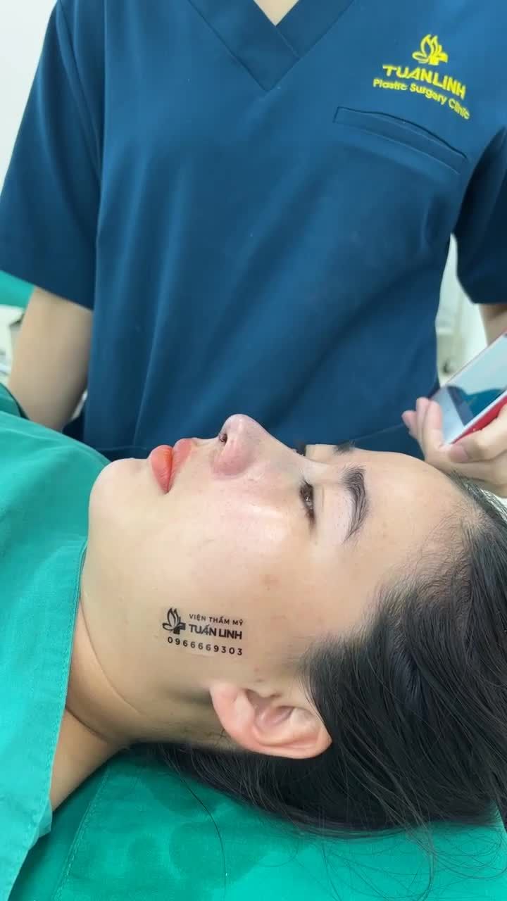 Case nâng mũi Siêu cấu trúc sụn surgiform lên dáng nhẹ nhàng cho bạn gái thích tự nhiên