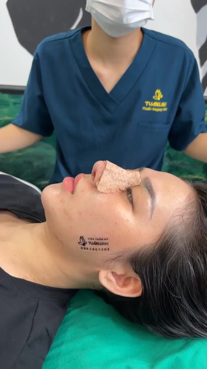 CHỈ SAU 10 NGÀY NÂNG MŨI THÁO NẸP BÁI BAI MŨI HẾCH, MŨI HỎNG