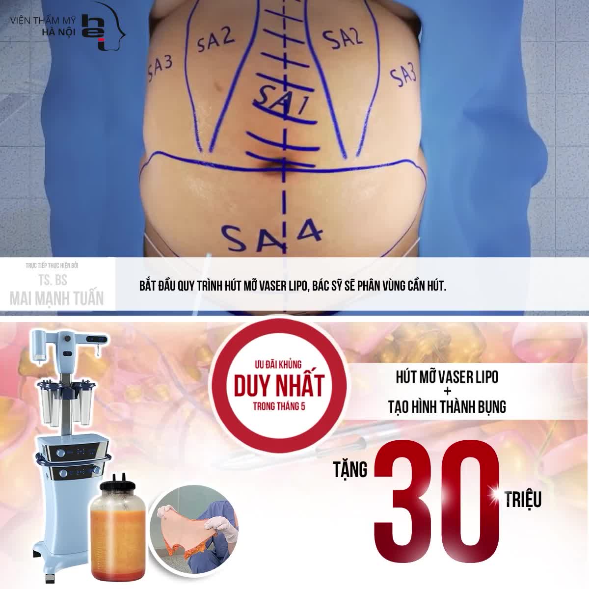 DUY NHẤT TRONG T5 - TẶNG NGAY 30TR HÚT MỠ VASER LIPO VÀ TẠO HÌNH THÀNH BỤNG