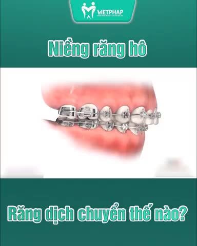 NIỀNG RĂNG HÔ RĂNG DỊCH CHUYỂN THẾ NÀO