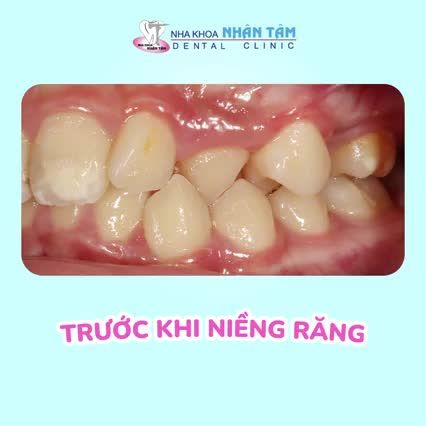 TẠM BIỆT NHÉ RĂNG KHẤP KHỂNH!