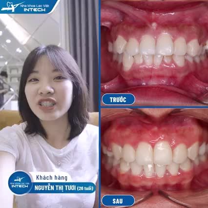 XÓA HÔ, GIẢI CHEN CHÚC NHỜ NIỀNG RĂNG TẠI LẠC VIỆT INTECH
