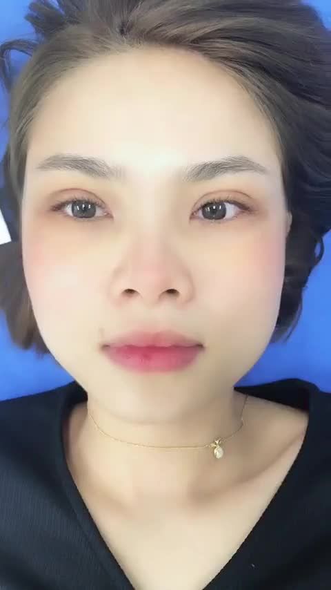 5 ngày sau cắt mí - Đường mí đẹp như vẽ! Cắt mí Plasma tại Kangnam Hà Nội