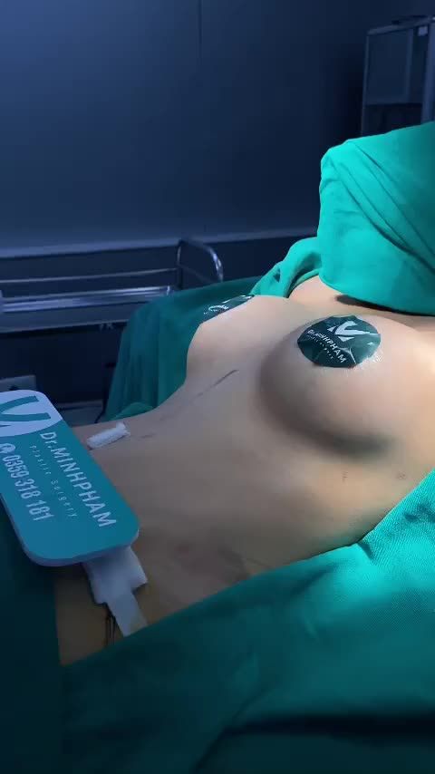 Ca Nâng Ngực Vừa Được Thực Hiện Bởi Ekip Dr. Minh Phạm