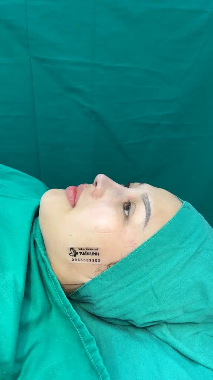 Dáng mũi siêu đẹp và tự nhiên sau 90 phút phẫu thuật.