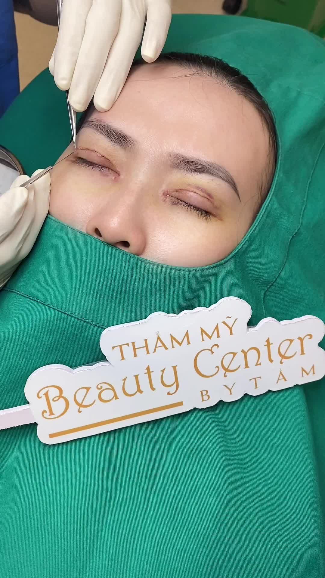 Combo mắt Perfect Eyes Cắt mí + mở góc trong sau 6 ngày thực hiện.