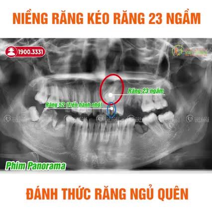 QUÁ TRÌNH KÉO RĂNG 23 MỌC NGẦM - ĐÁNH THỨC RĂNG NGỦ QUÊN