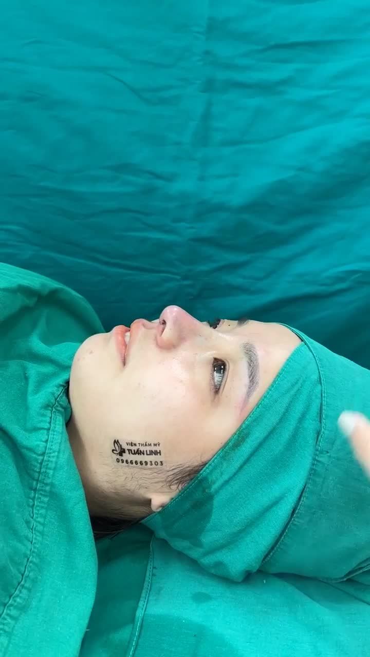 TỰ TIN KHOE NGAY GÓC NGHIÊNG THẦN THÁI SAU NÂNG MŨI CẤU TRÚC TẠI TUẤN LINH.