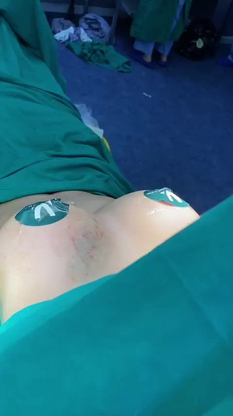 Ca Nâng Ngực Vừa Được Thực Hiện Bởi Ekip Dr. Minh Phạm