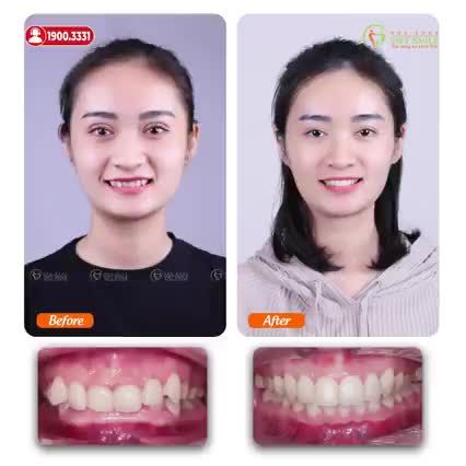 CẢM XÚC SAU THÁO NIỀNG - HỐI HẠN VÌ KHÔNG NIỀNG SỚM