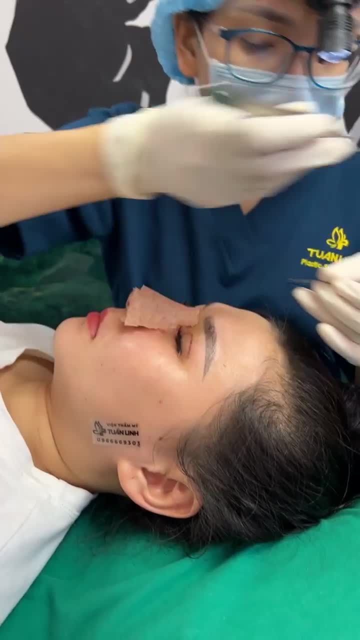 Case Nâng mũi Siêu cấu trúc sụn surgiform + cắt mí + mở góc mắt được 10 ngày cho bạn gái đến từ Đồng Tháp