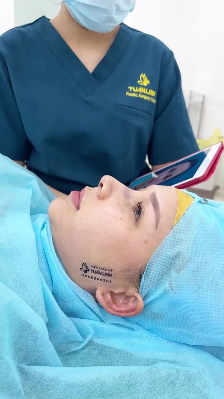 Case Nâng mũi Siêu cấu trúc sụn Surgiform có xử lí xương gồ lên dáng siêu mềm mại và thanh tú.