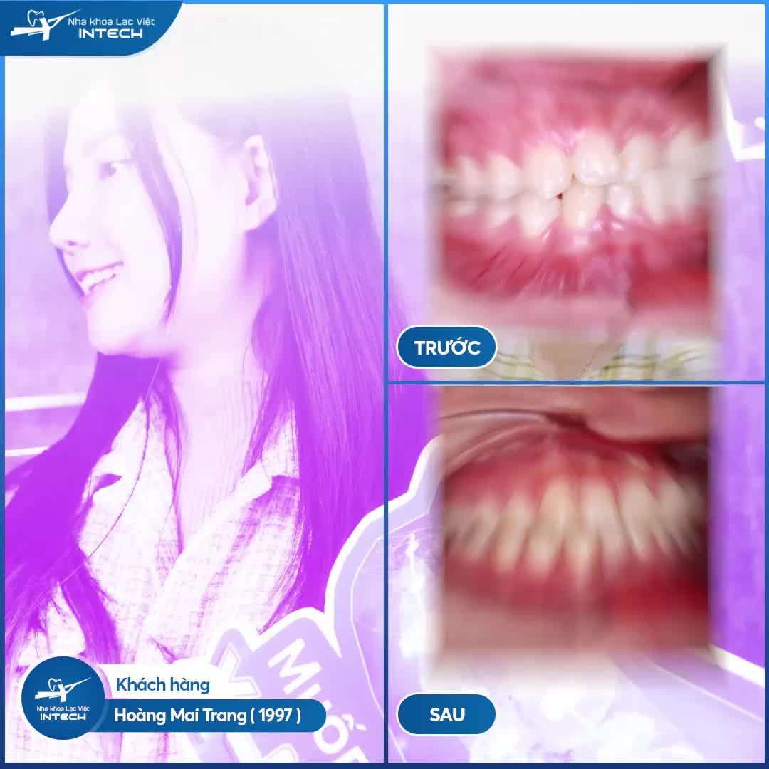 NIỀNG RĂNG KHỚP CẮN CHÉO, SỞ HỮU NỤ CƯỜI TỰ TIN SAU 18 THÁNG