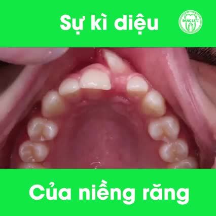 Niềng răng - một hành trình vừa đủ để tạo nên sự thay đổi ngoạn mục cho hàm răng & nụ cười của bạn!