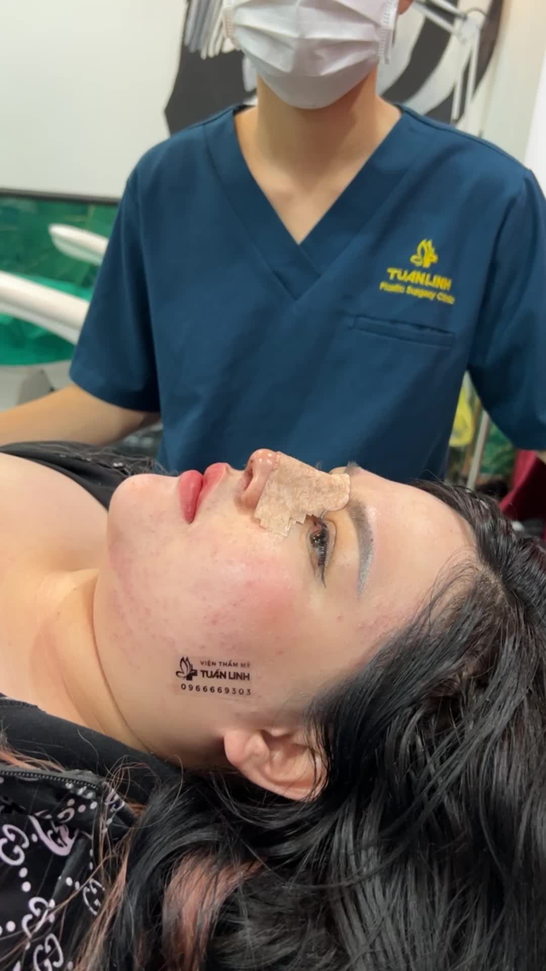 Case Nâng mũi cấu trúc được 4 ngày - khách hàng đến Viện thay nẹp và vệ sinh vết thương.