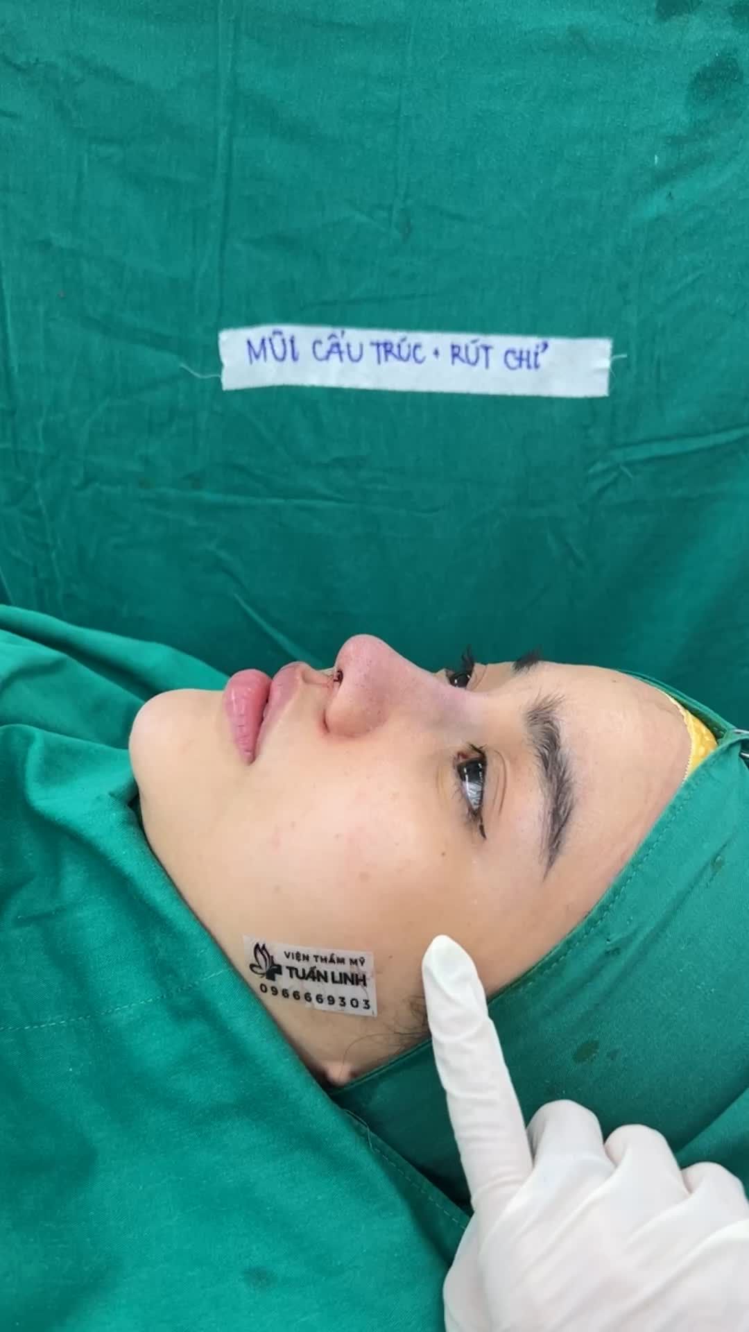 Nâng mũi cấu trúc + rút chỉ sụn Surgiform vừa hoàn thành sau 90 phút