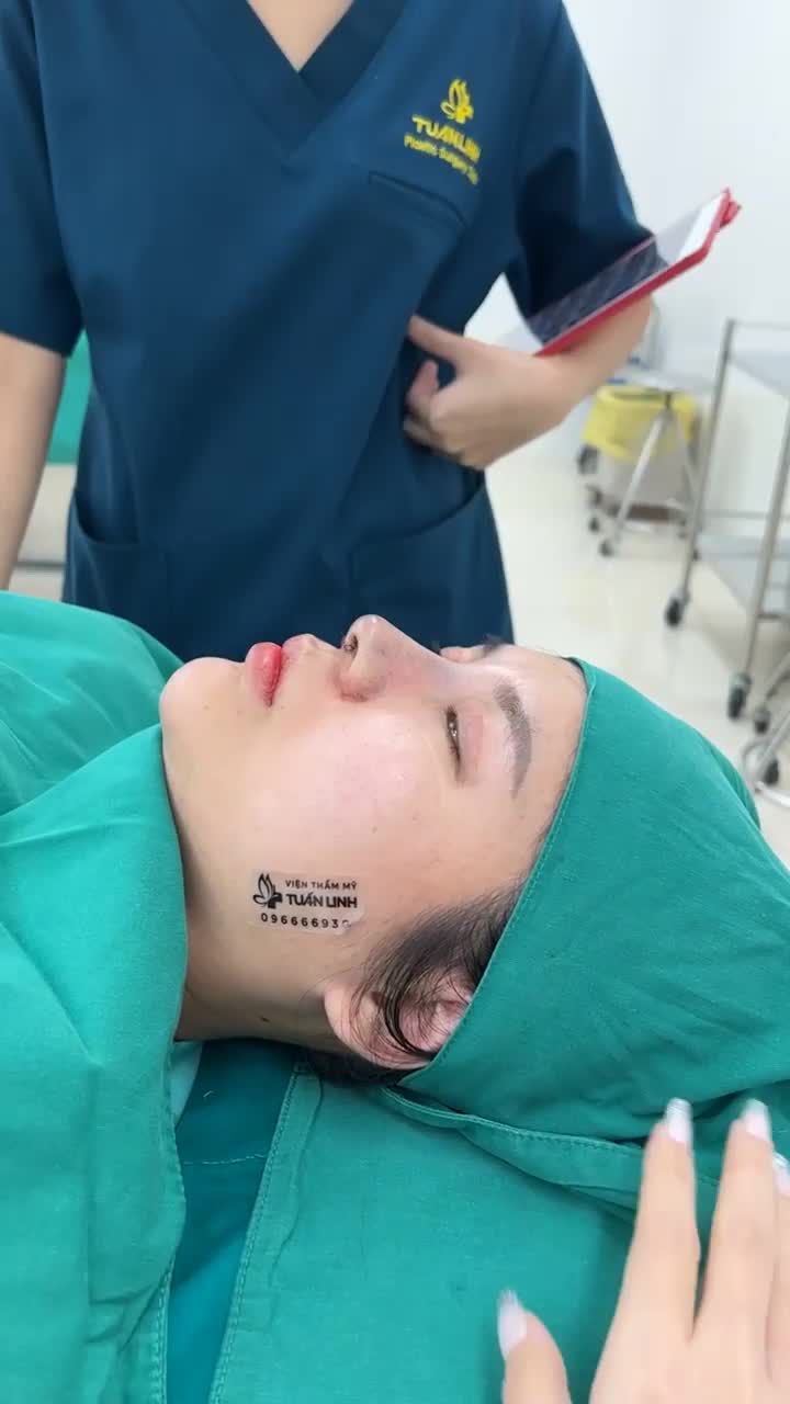 Case nâng mũi cấu trúc sửa lại sụn Surgiform cho bạn gái đến từ NHA TRANG.