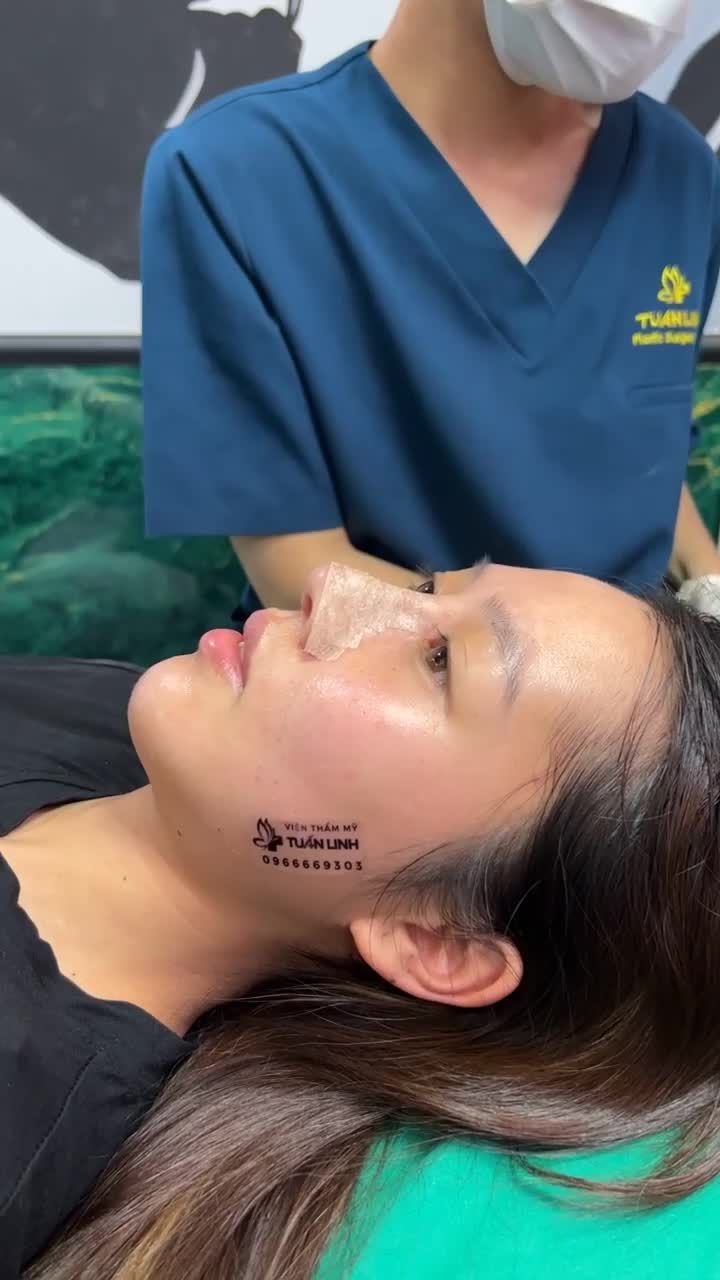 Tái khám sau 10 ngày Nâng mũi Siêu cấu trúc sụn Surgiform