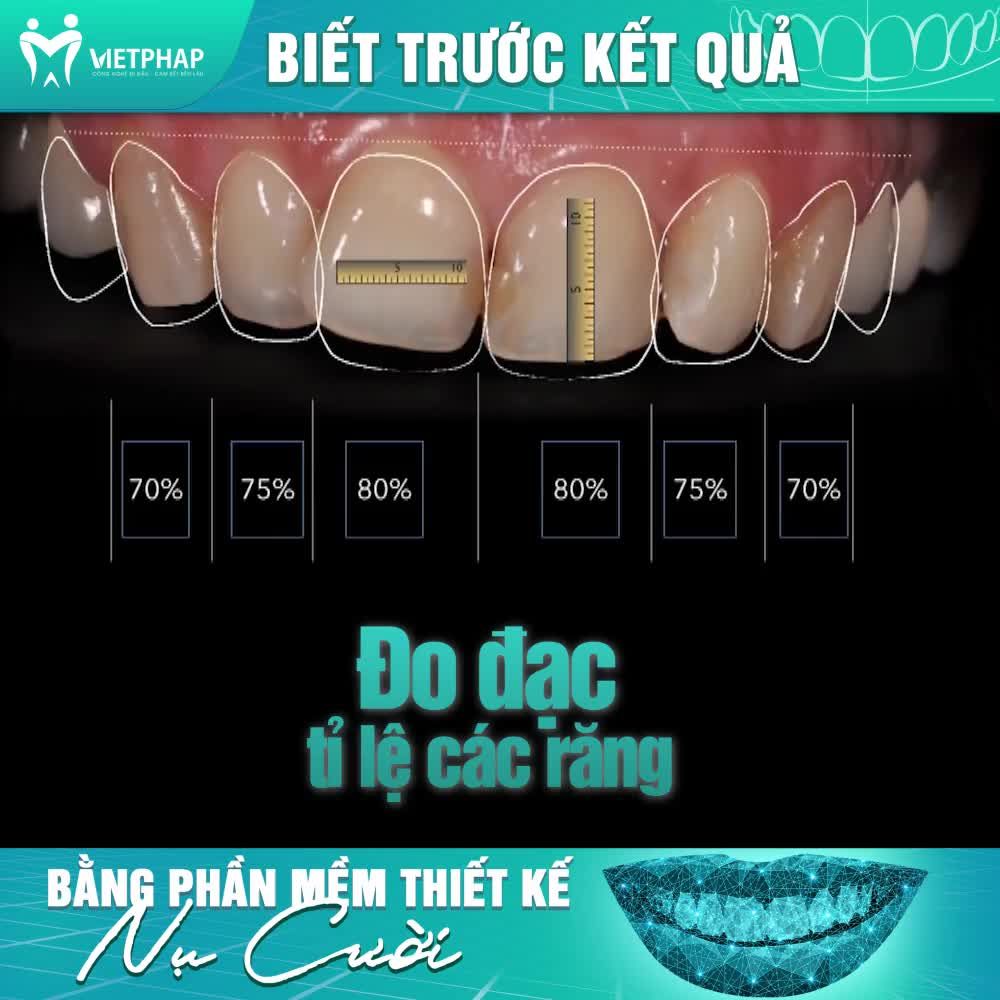 BIẾT TRƯỚC KẾT QUẢ BẰNG CÔNG NGHỆ THIẾT KẾ NỤ CƯỜI- SMILE DESIGN