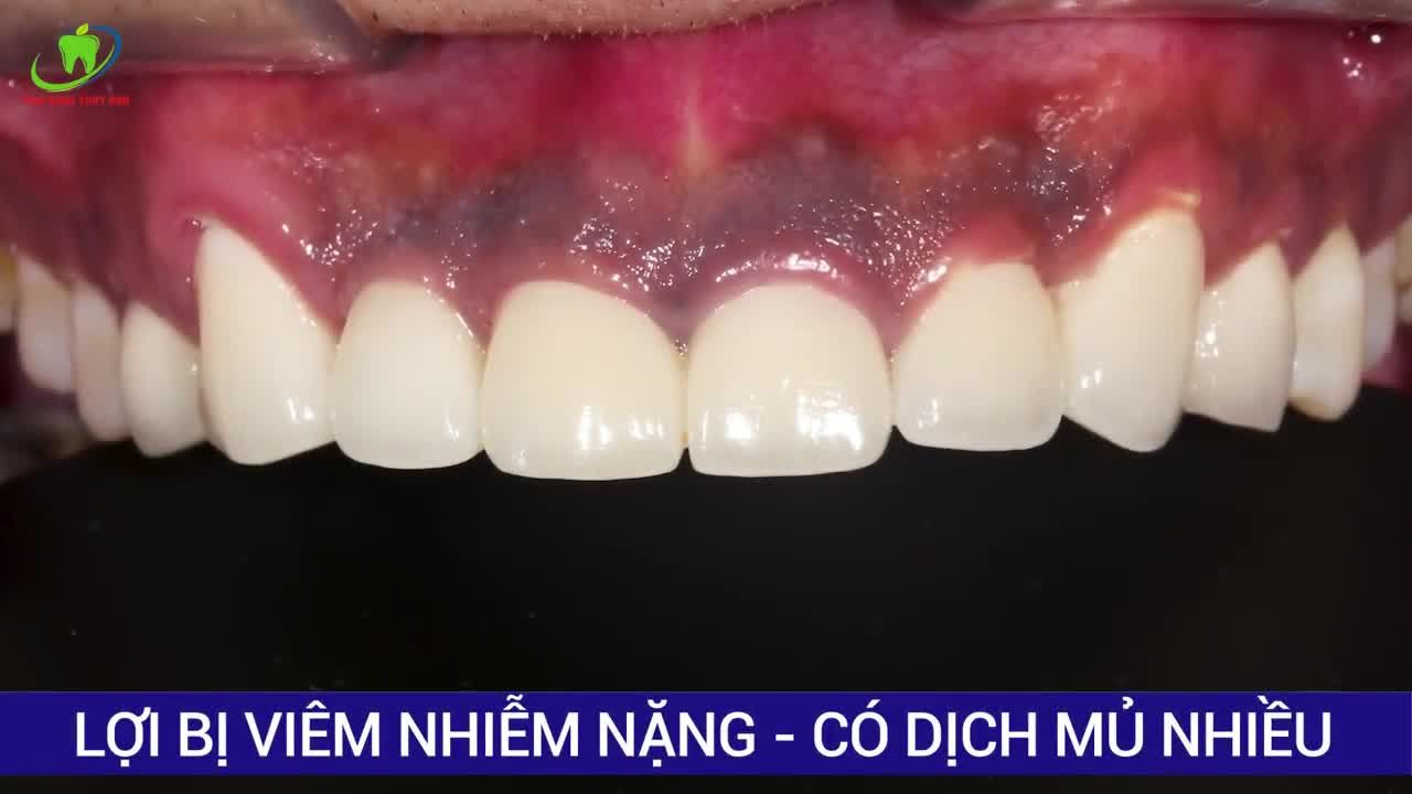 BỌC SỨ SAI CHỈ ĐỊNH GÂY VIÊM LỢI NẶNG