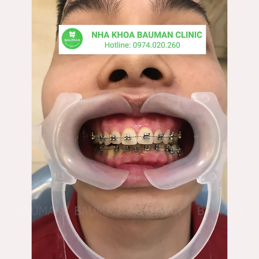 Ca niềng răng 5219| Nha Khoa Bauman