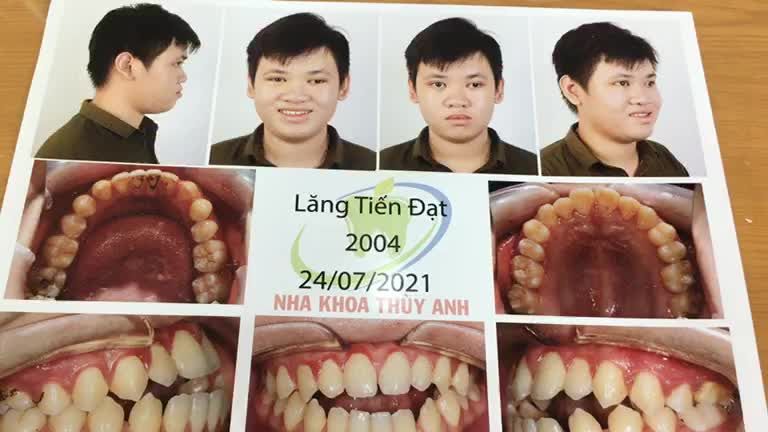 Ca cắm 2 minivis hàm dưới hỗ trợ giảm hô cho bạn khách hàng tại Nha Khoa Thuỳ Anh.