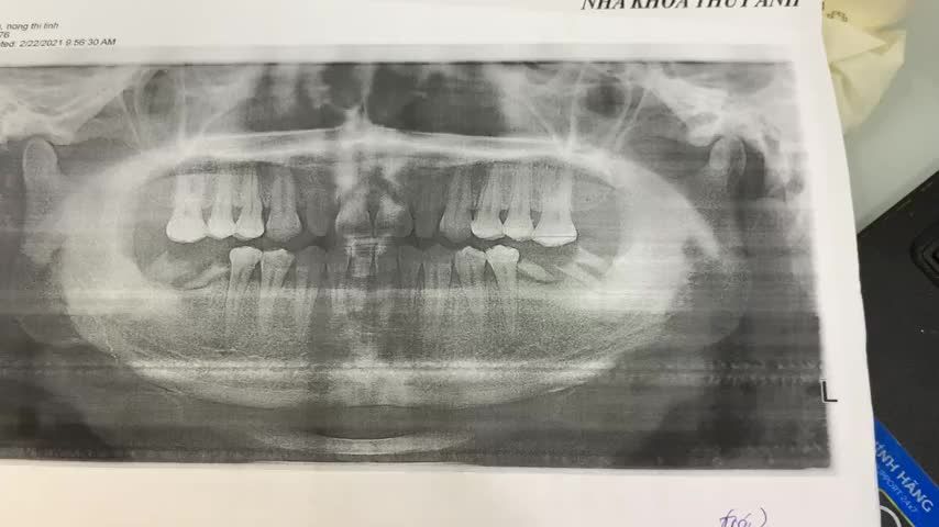 Ca cấy Implant răng 36 cho khách hàng tại Nha Khoa Thuỳ Anh.