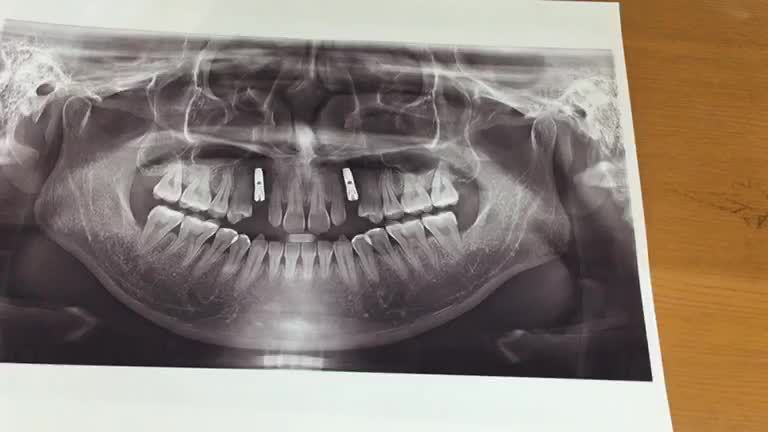 Ca lắp răng Implant cho anh khách hàng tại Nha Khoa Thuỳ Anh.