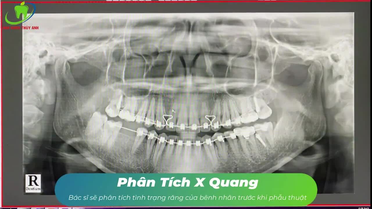 CASE ĐIỀU TRỊ KẾT HỢP GIỮA BÁC SĨ CHỈNH NHA VÀ BÁC SĨ PHỤC HÌNH