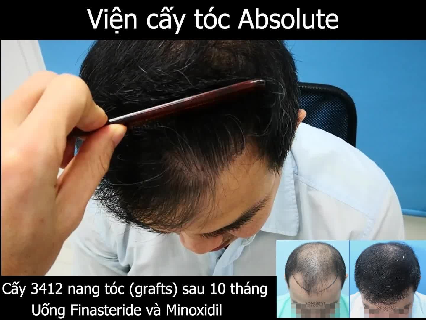 Kết quả cấy 3412 nang tóc trị hói chữ M và hói đỉnh đầu sau 10 tháng