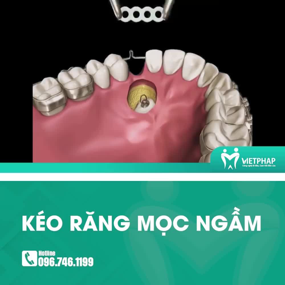 KÉO RĂNG MỌC NGẦM BẰNG PHƯƠNG PHÁP CHỈNH NHA