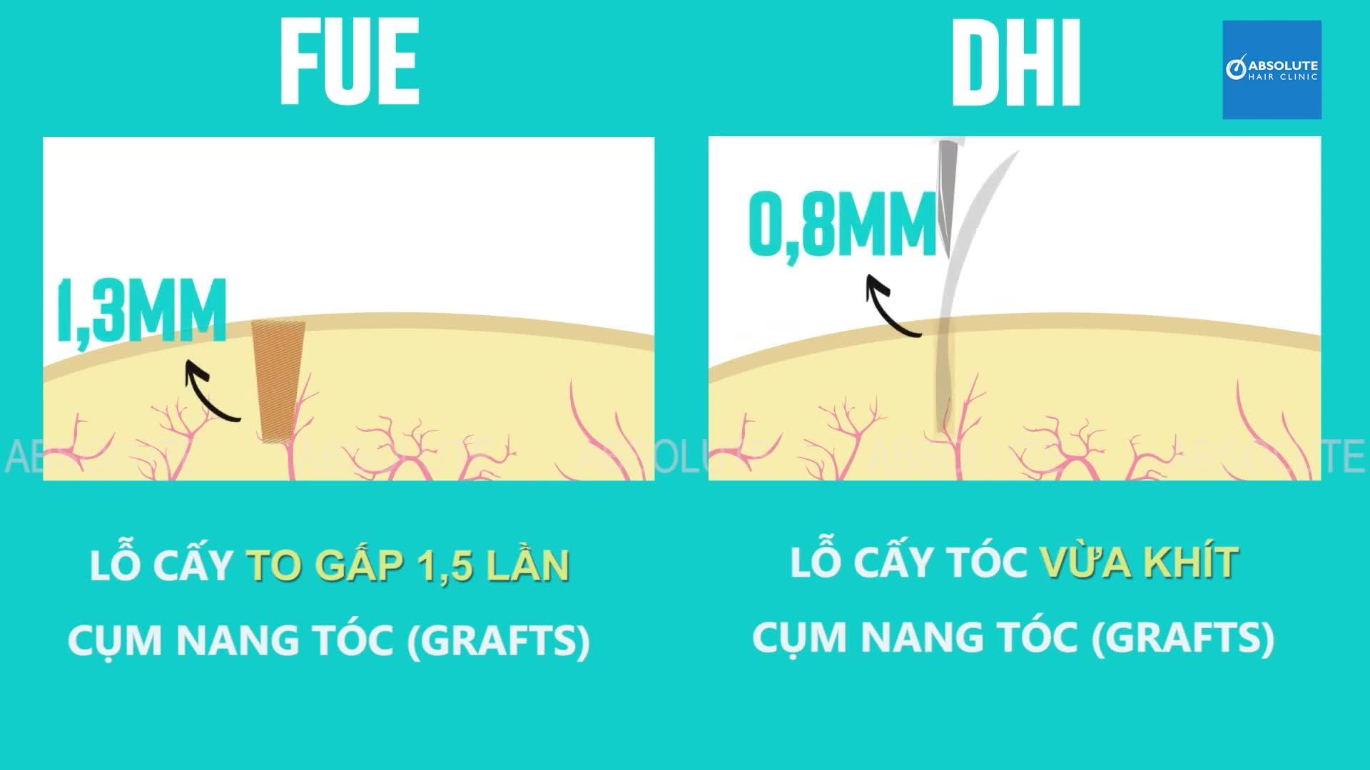 Sự khác nhau giữa cấy tóc DHI so với cấy tóc FUE truyền thống